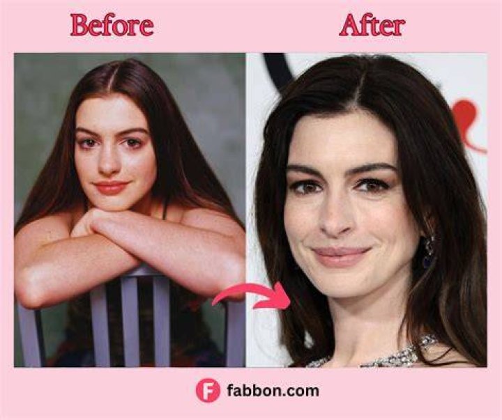 Anne Hathaway Plastic Surgery Before and After