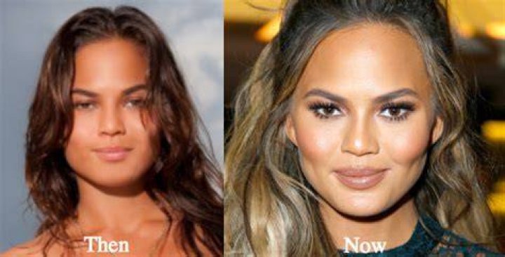 chrissy teigen plastic surgery