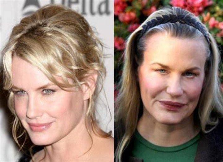 Daryl Hannah Plastic Surgery Before and After Botox Injections