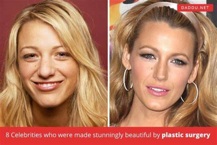 Diane Kruger Plastic Surgery Before and After