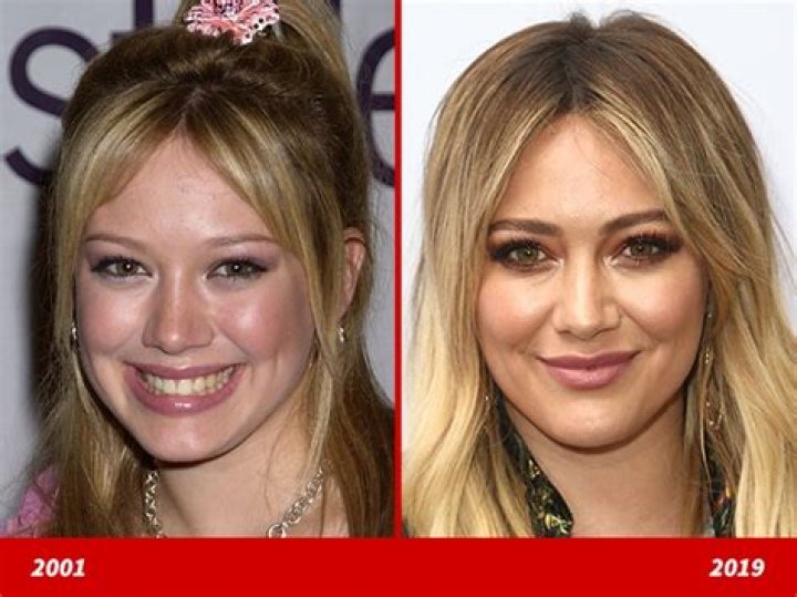 Hilary Duff Plastic Surgery Before and After