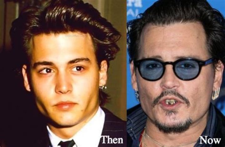 Johnny Depp Plastic Surgery Before and After