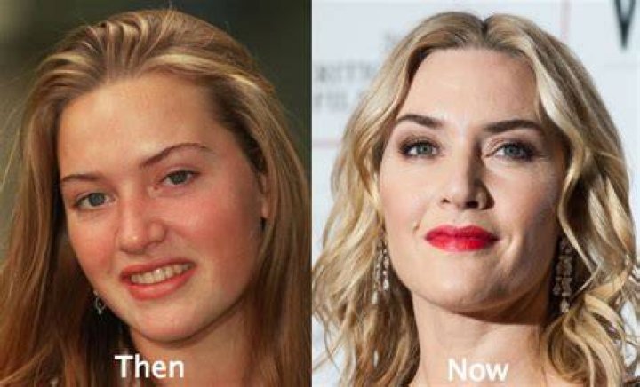 Kate Winslet Plastic Surgery Before and After