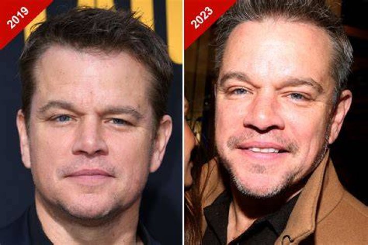 Matt Damon Plastic Surgery Before and After