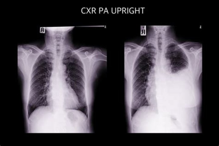 Mesothelioma Find Out About Explores New Remedy When Chemotherapy Fails