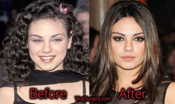 Mila Kunis Plastic Surgery Before and After