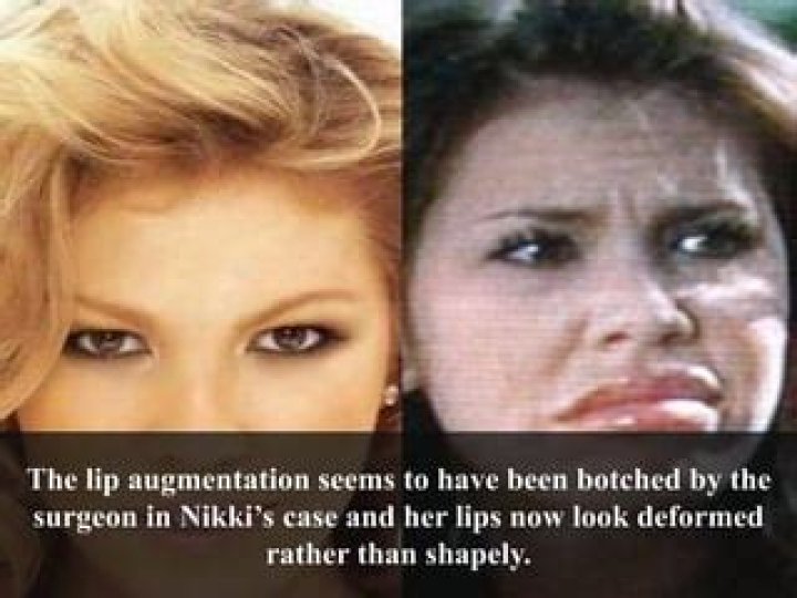 Nikki Cox Lip Augmentation Plastic Surgery Before and After