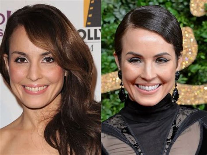 Noomi Rapace Plastic Surgery Before and After