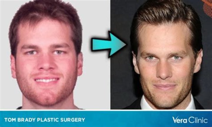 Tom Brady Plastic Surgery